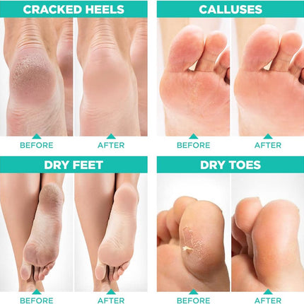 2 Pairs of Foot Masks - Exfoliating Foot Mask for Dry, Cracked Feet - Professional Foot Mask - Removes Dead Skin and Calluses - Smoothes Your Feet - Natural Treatment Exfoliating Foot Mask - Restores Rough Heels